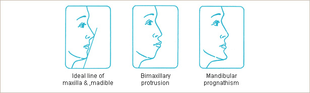 Indication of surgery