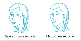 Postoperative care