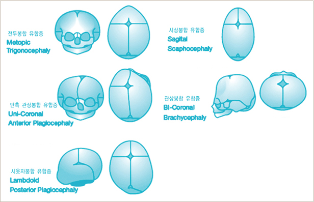 Types of craniosynostosis