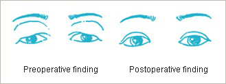 Upper blepharoplasty